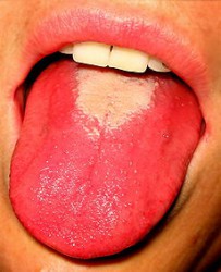 Strawberry tongue - Image from Wikimedia Commons