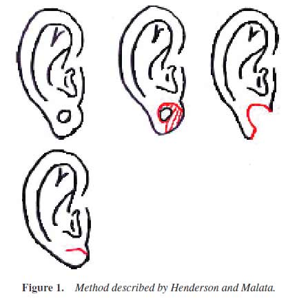 Ear-Gauge-Remedy