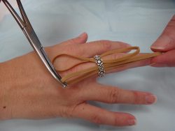 Two rubber band technique for finger ring removal